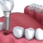 Implantes dentales, tipos y precios